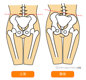 骨と筋肉の異常によって起こる股関節の痛み 御徒町のパワーマグネット整体 リラクゼーションスマイル 東京都台東区御徒町にある整体 肩こり 腰痛 歪み等を解決